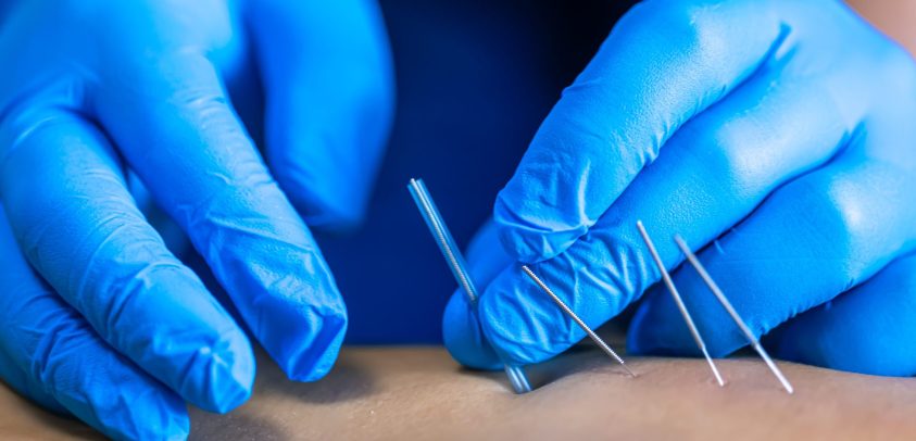 Close up of a needle and hands of physiotherapist doing a dry needling in a physiotherapy center.
